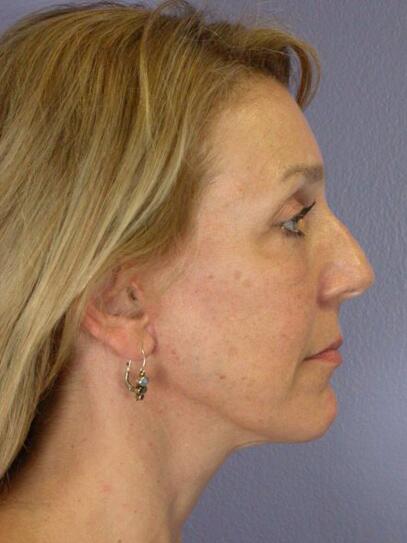 Facelift Before & After Image