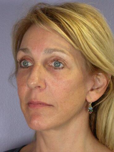 Facelift Before & After Image