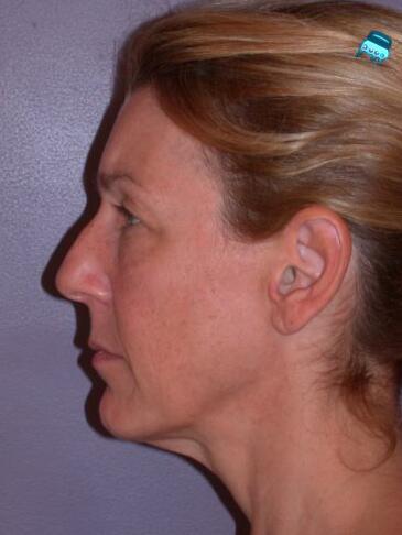 Facelift Before & After Image