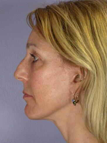 Facelift Before & After Image