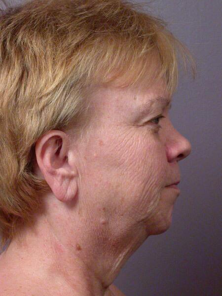 Facelift Before & After Image