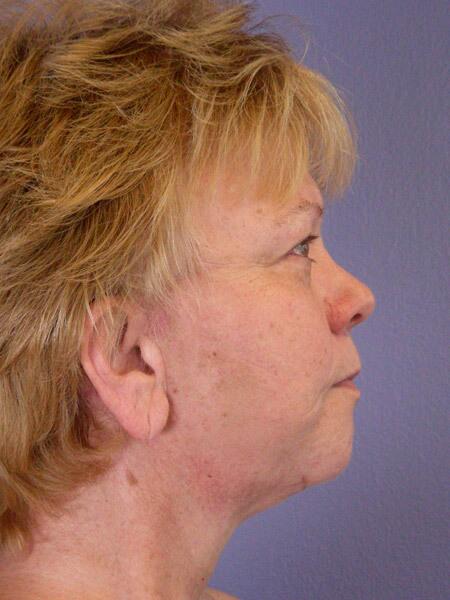 Facelift Before & After Image