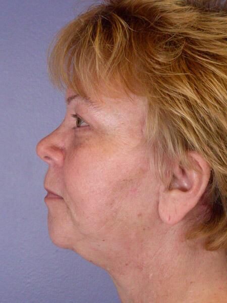 Facelift Before & After Image