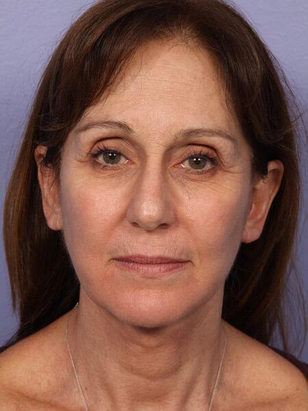 Facelift Before & After Image