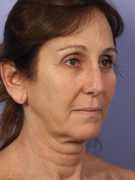 Facelift Before & After Image