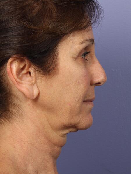 Facelift Before & After Image