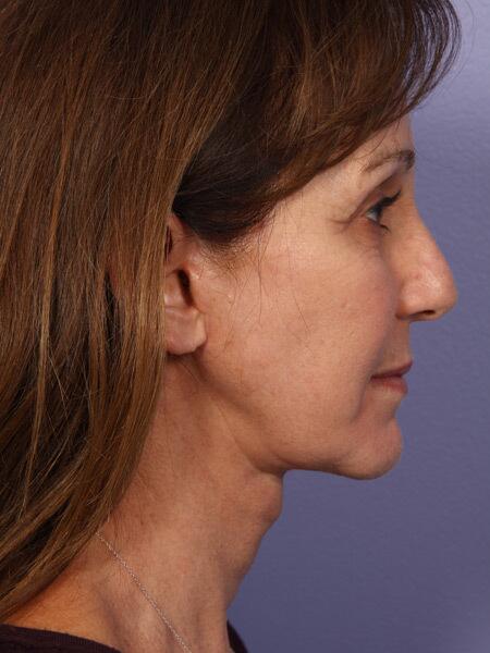 Facelift Before & After Image