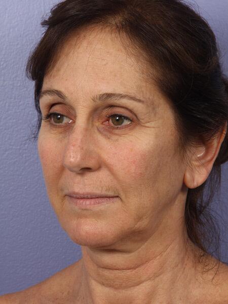 Facelift Before & After Image