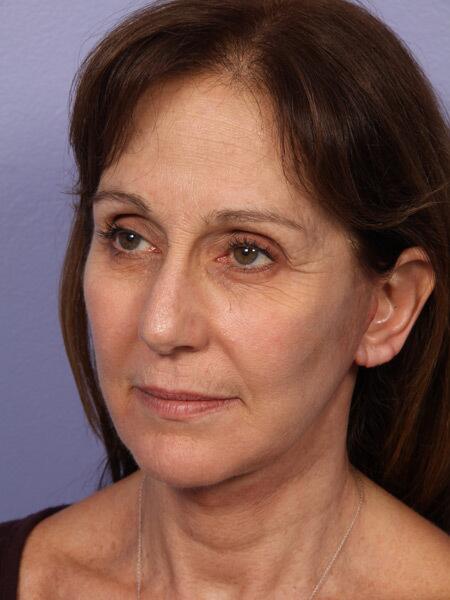 Facelift Before & After Image