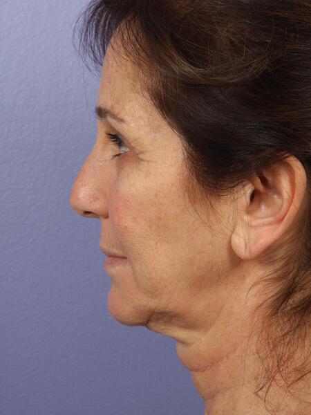 Facelift Before & After Image