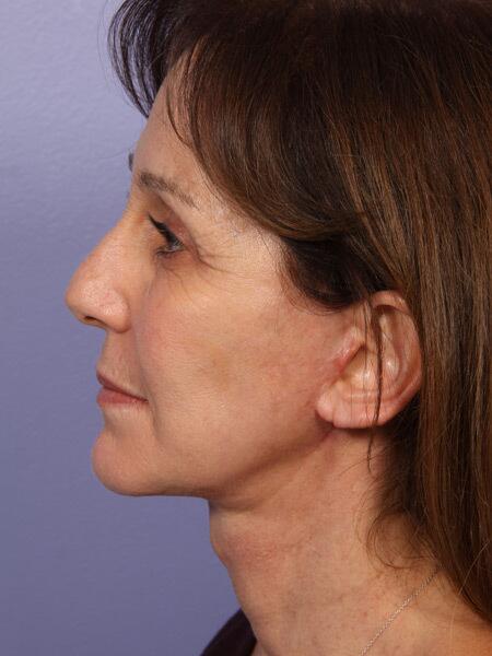 Facelift Before & After Image