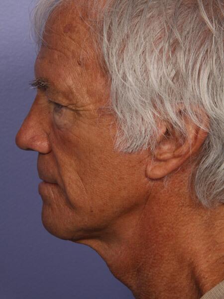 Facelift Before & After Image