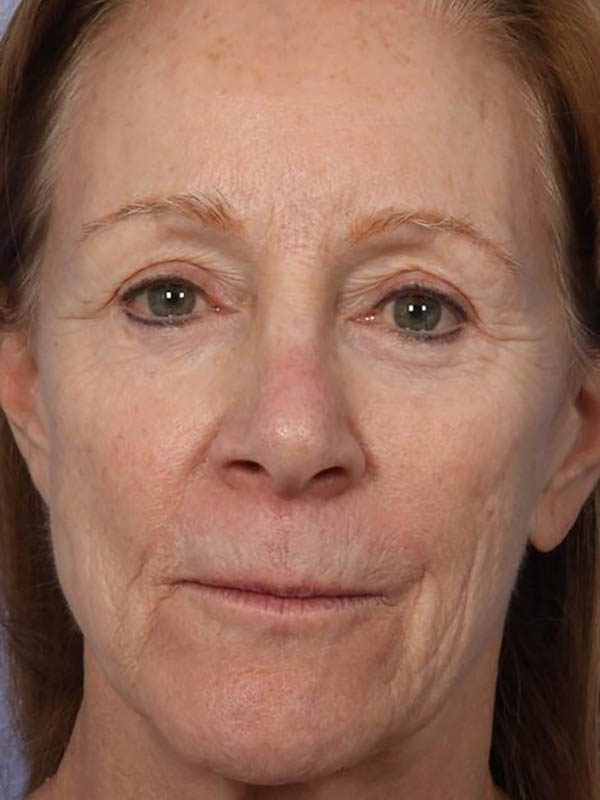 Facelift Before & After Image