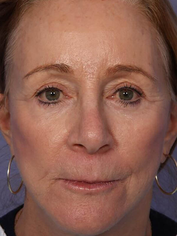 Facelift Before & After Image