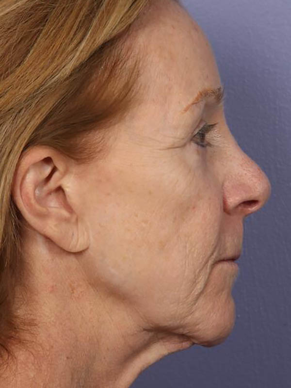 Facelift Before & After Image