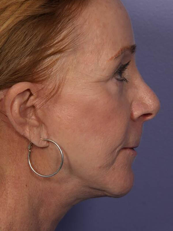 Facelift Before & After Image