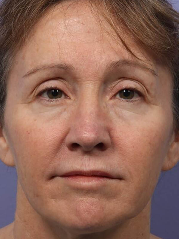 Facelift Before & After Image