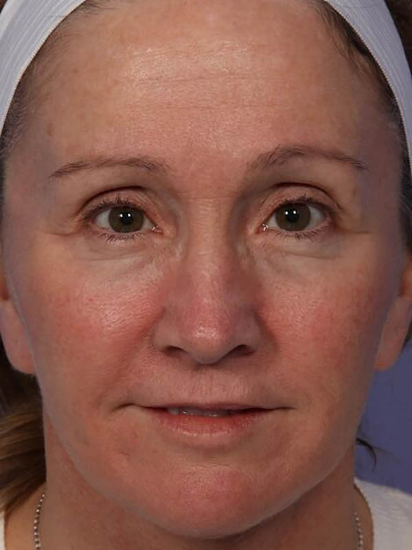 Facelift Before & After Image