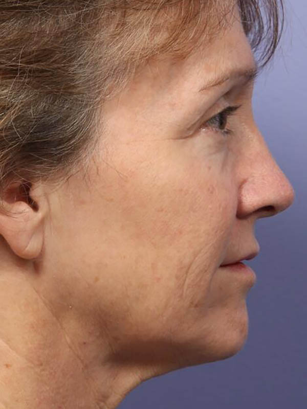 Facelift Before & After Image