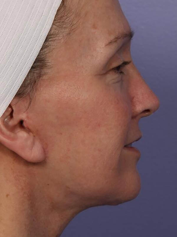 Facelift Before & After Image