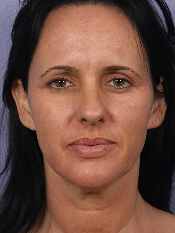 Facelift Before & After Image