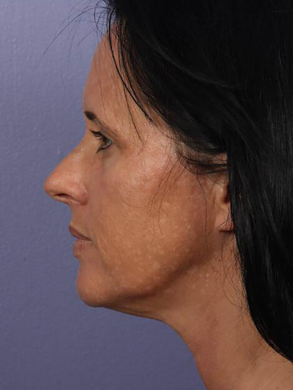 Facelift Before & After Image