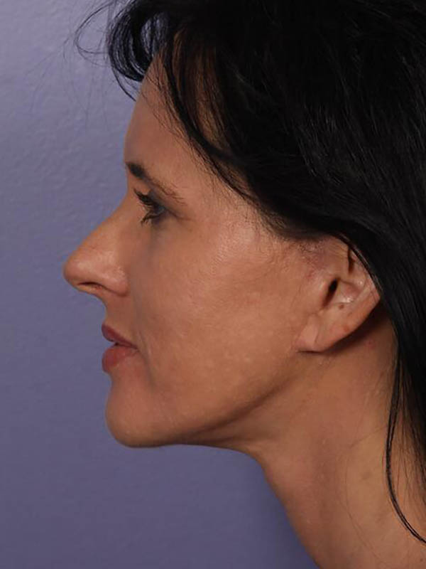 Facelift Before & After Image