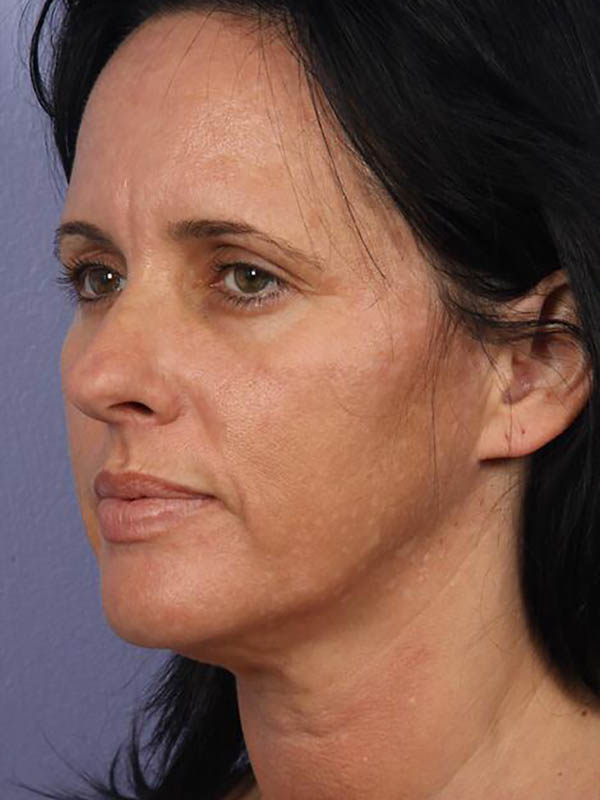 Facelift Before & After Image