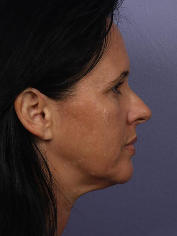 Facelift Before & After Image