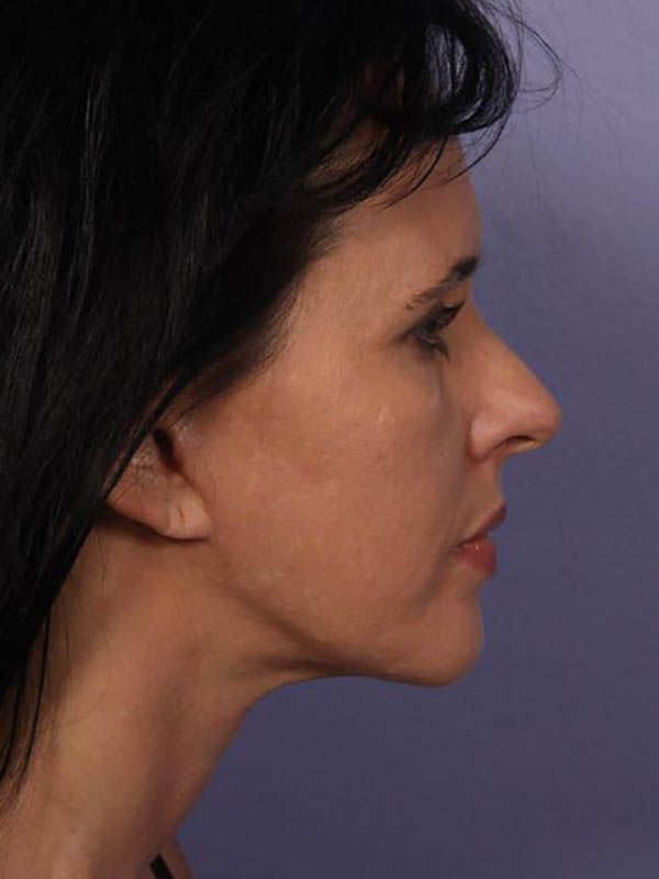 Facelift Before & After Image