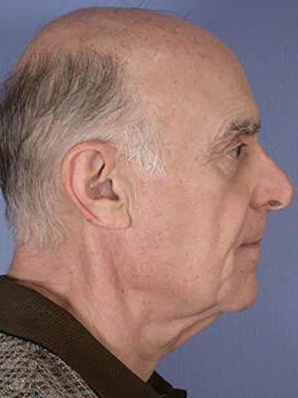 Facelift Before & After Image