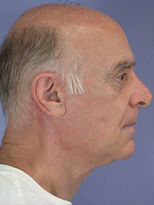 Facelift Before & After Image