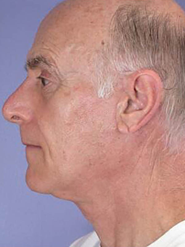 Facelift Before & After Image