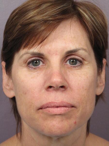 Facelift Before & After Image