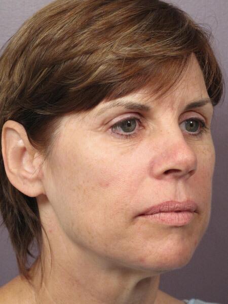 Facelift Before & After Image