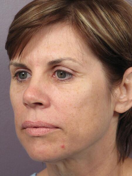 Facelift Before & After Image