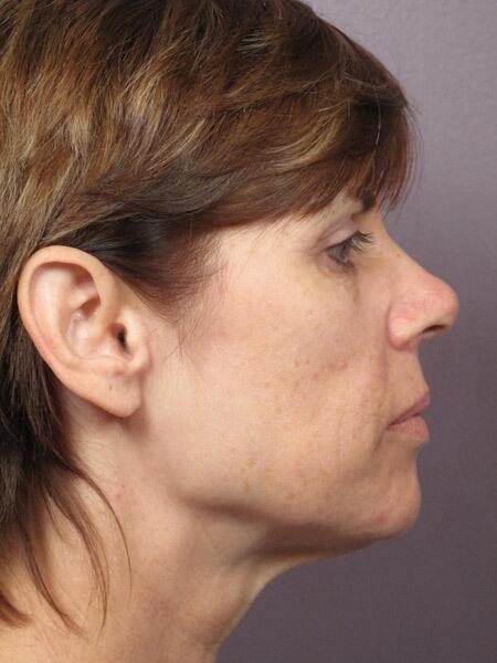 Facelift Before & After Image