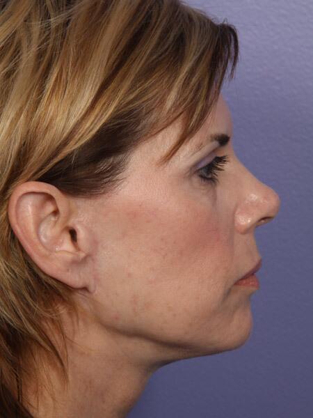 Facelift Before & After Image