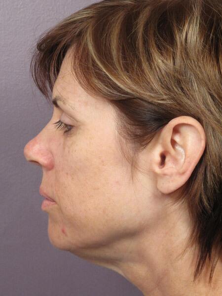 Facelift Before & After Image