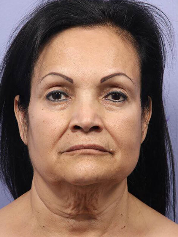 Facelift Before & After Image