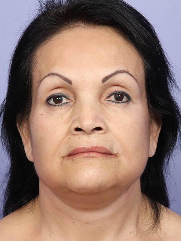 Facelift Before & After Image