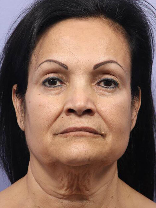 Facelift Before & After Image