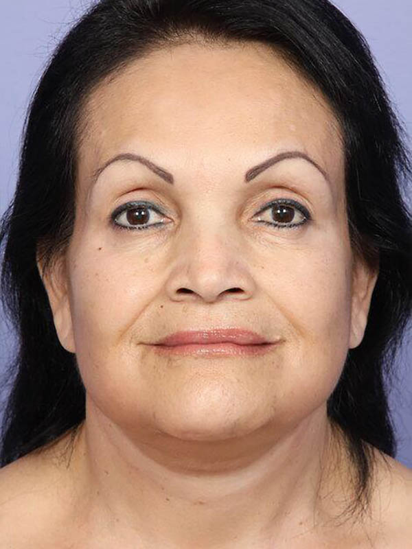 Facelift Before & After Image