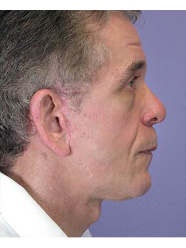 Facelift Before & After Image