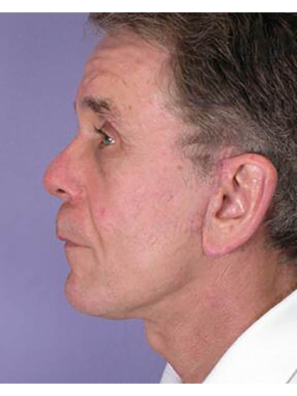 Facelift Before & After Image