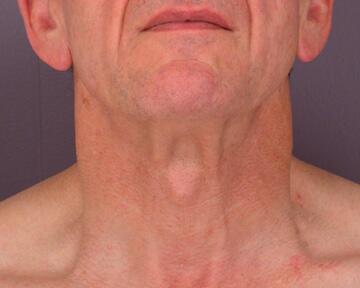 Facelift Before & After Image