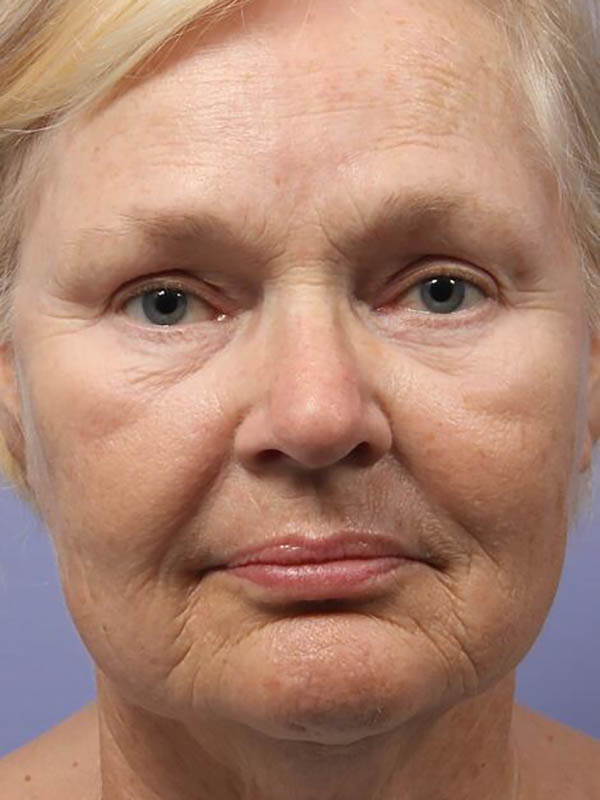 Facelift Before & After Image