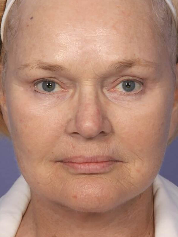 Facelift Before & After Image