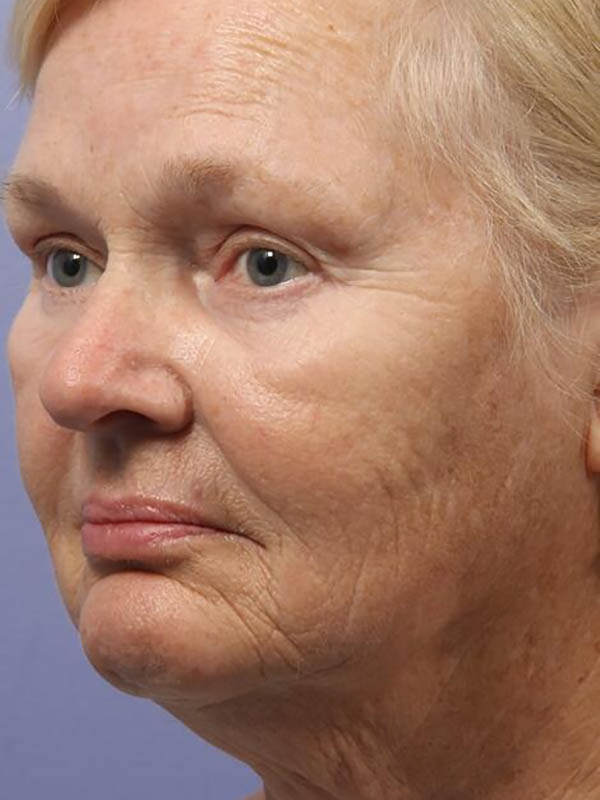 Facelift Before & After Image