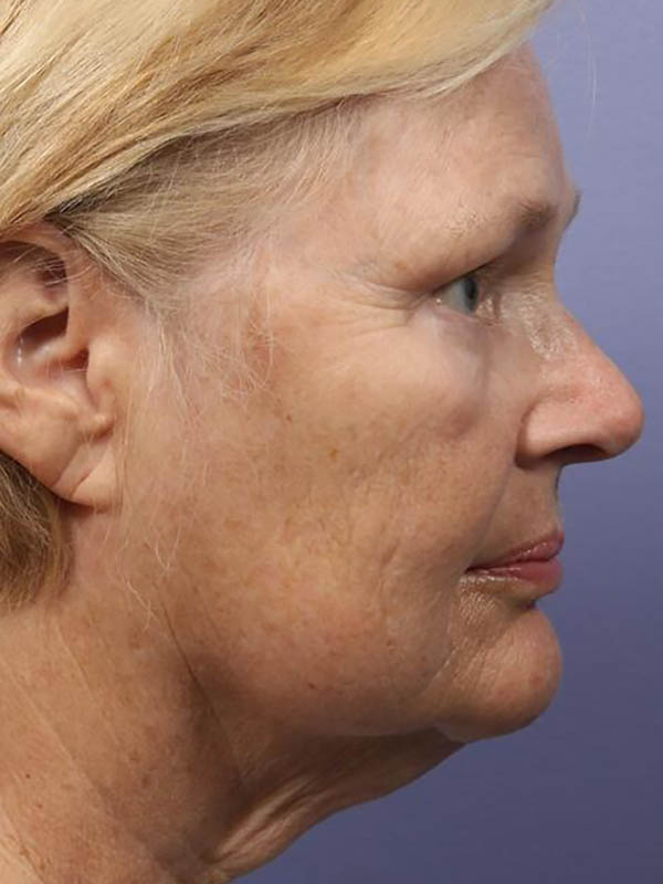 Facelift Before & After Image